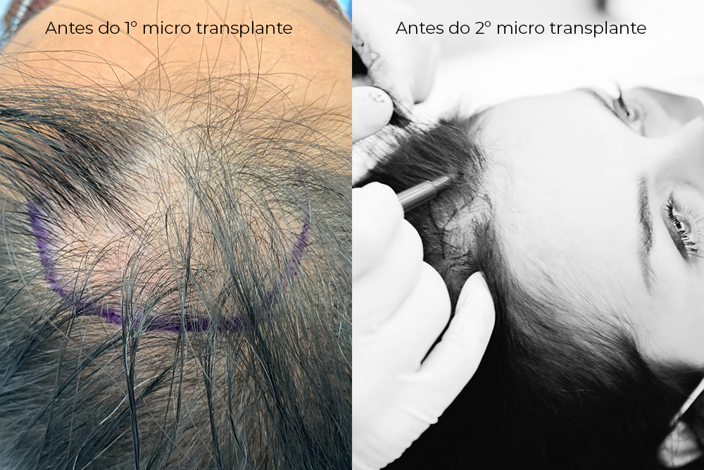 transplante capilar antes e depois