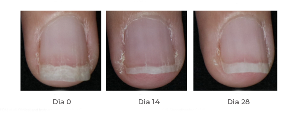 si nails isdin antes e depois before and after